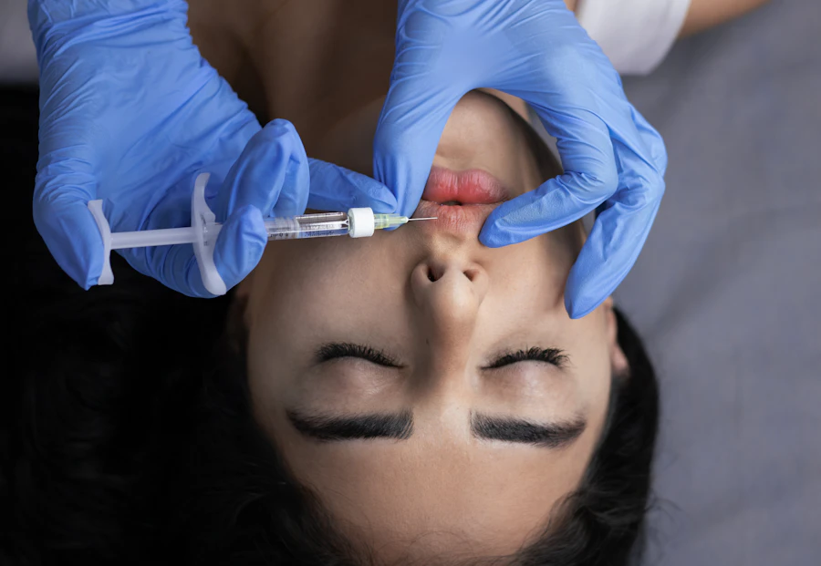 A practitioner administering lip filler with a fine syringe